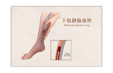 協(xié)和醫(yī)護(hù)專家教你3個動作防“血栓” 隨時隨地動起來