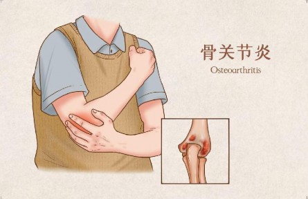 生活中怎樣預防骨關節(jié)炎？