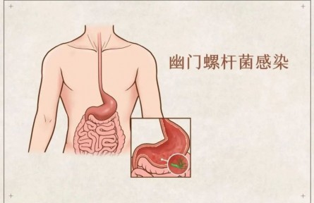 辟謠 | 吃大蒜能殺幽門螺桿菌？真的假的？