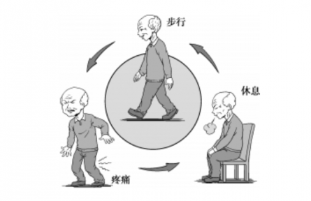健康問答|什么是間歇性跛行？